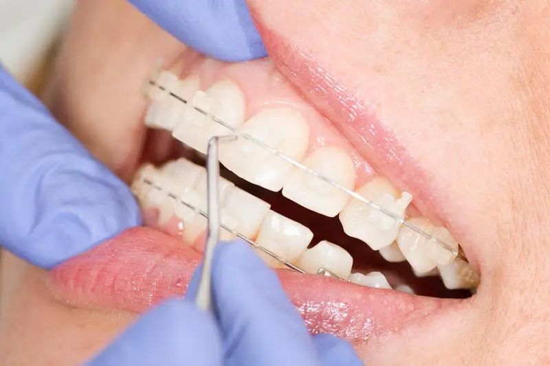 Khám phá chi tiết ưu nhược điểm các loại niềng răng phổ biến nhất.